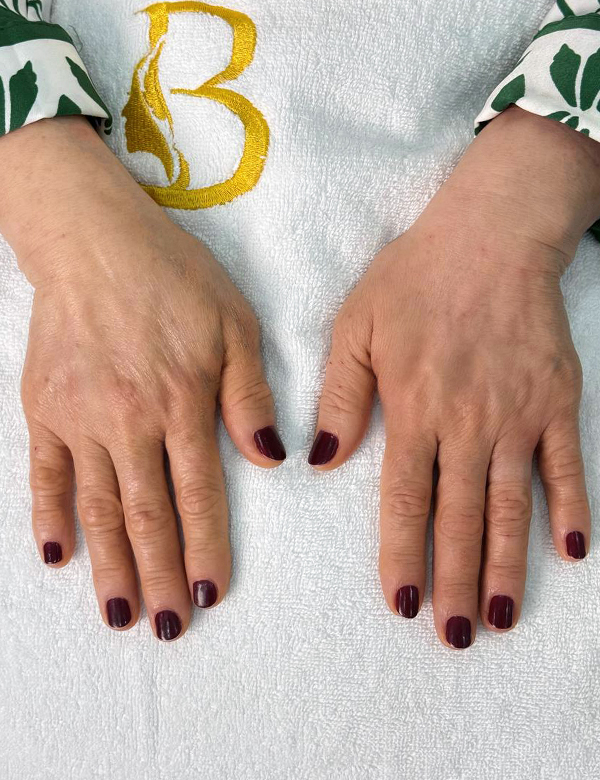 After hands filler treatment
